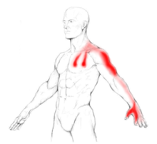 Arm / Hand Numbness — Thoracic Outlet Syndrome