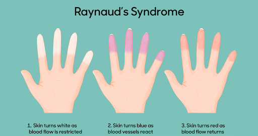 Raynaud's Syndrome