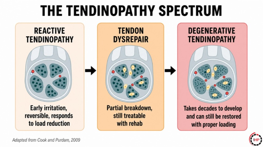 The tendinopathy spectrum from reactive tendinopathy through tendon dysrepair to degenerative tendinopathy