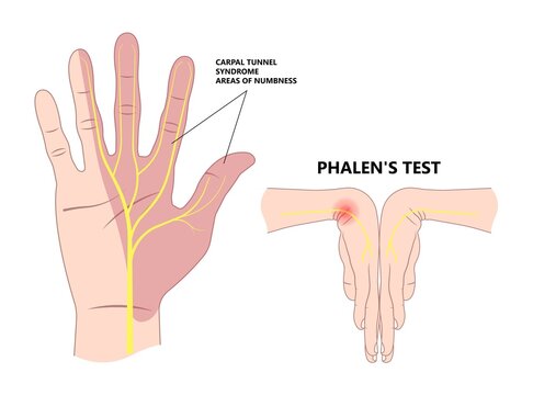 Phalen's test and median nerve areas of numbness for carpal tunnel syndrome