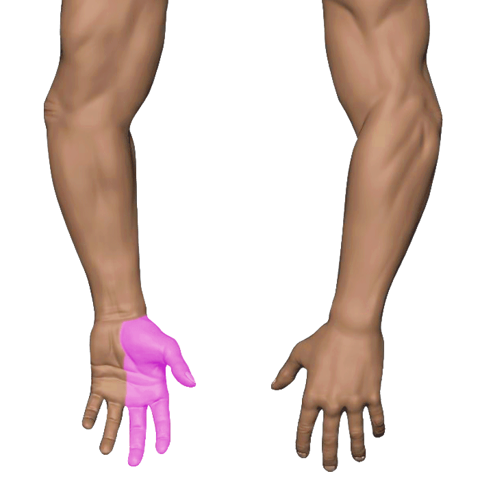 Palm Numbness / Tingling — Carpal Tunnel Syndrome