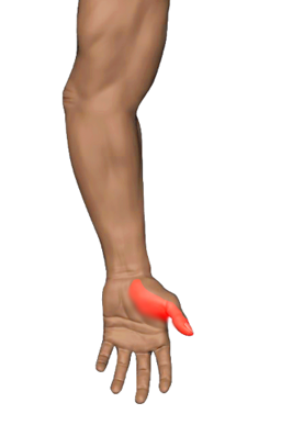 Palm Side Thumb Pain — Game Over Grip · Thenar Eminence Strain