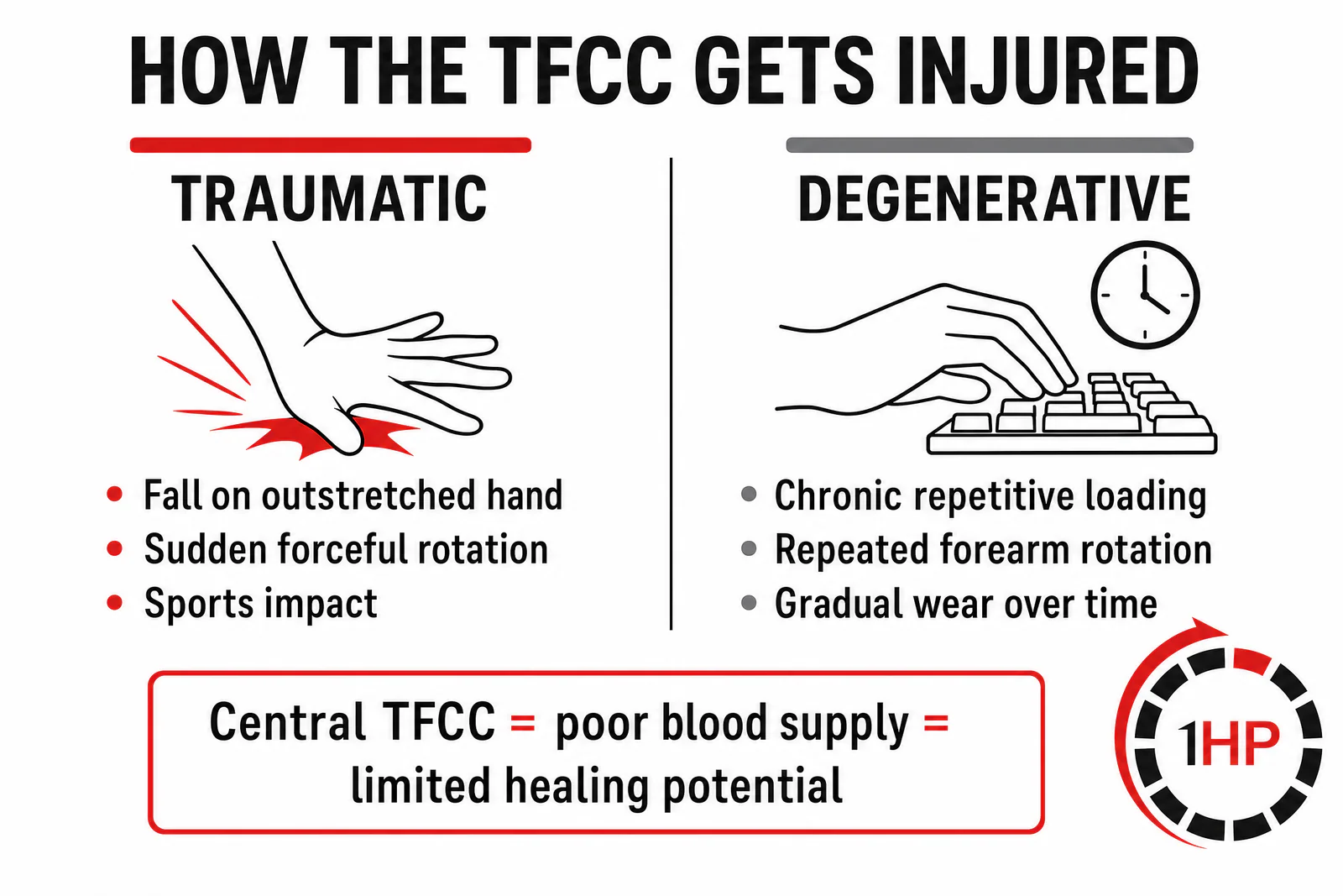 Traumatic vs degenerative pathways for TFCC tear wrist pain